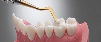  The Lifespan of Dental Fillings: How to Extend Their Durability and Effectiveness